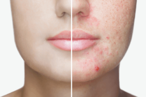 Acne