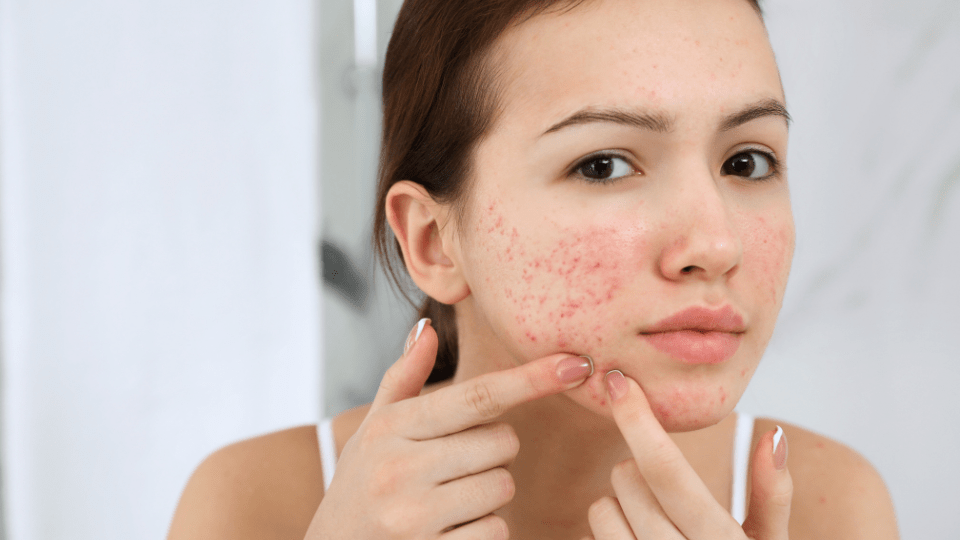 acne treatment manchester