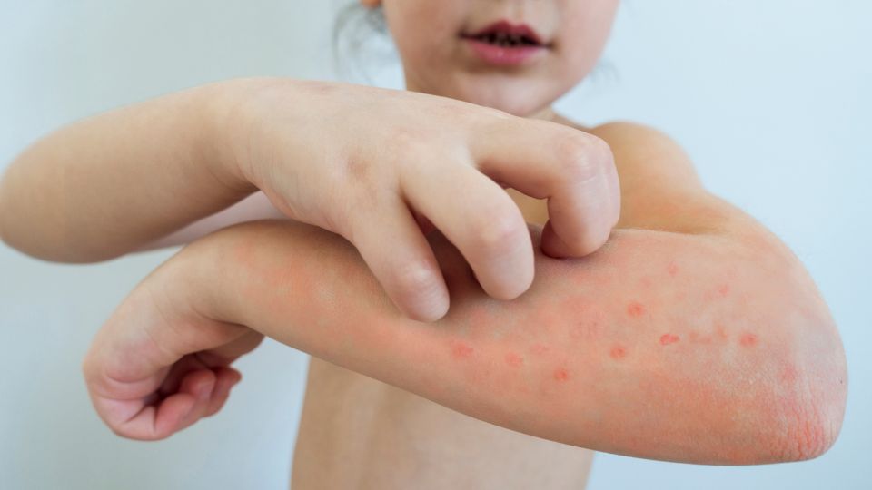 chickenpox vaccine manchester