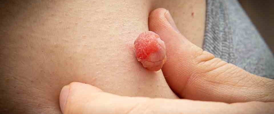 How to remove skin tags safely in Manchester