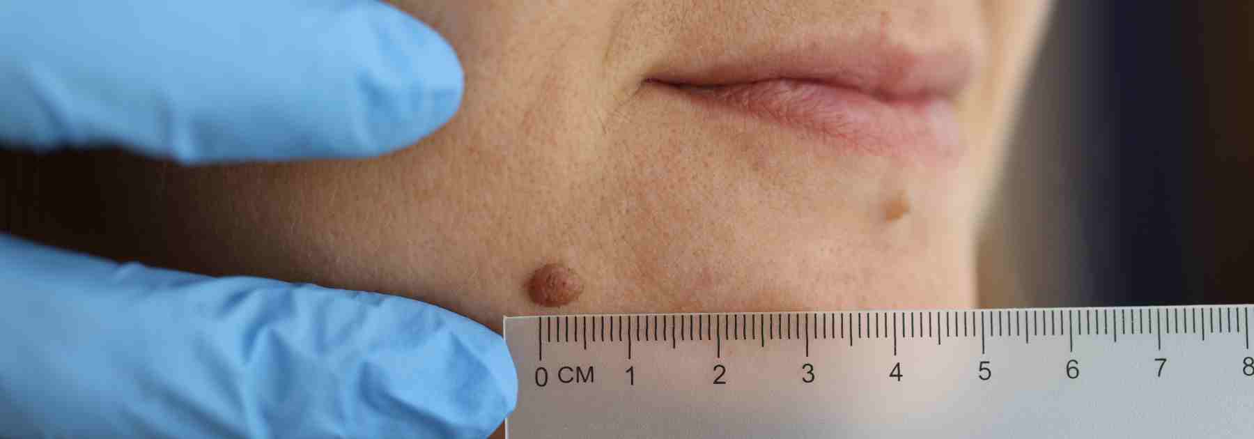 Book facial wart removal in Manchester