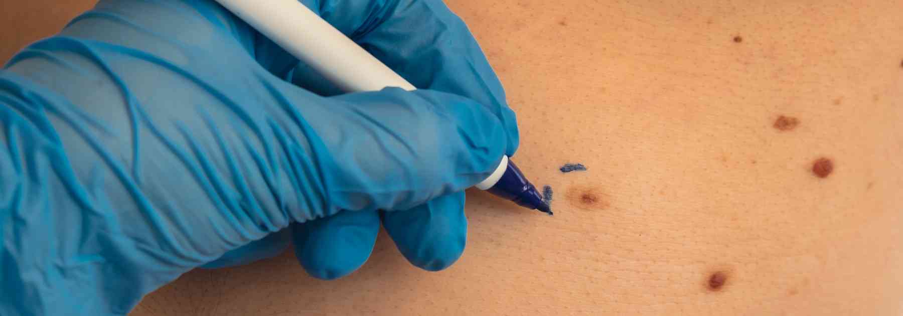 Private skin tag removal near me