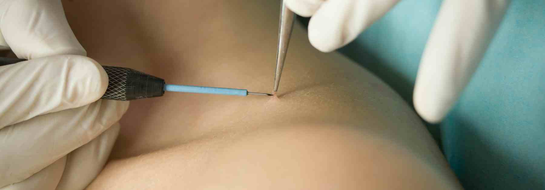 Professional skin tag removal near me