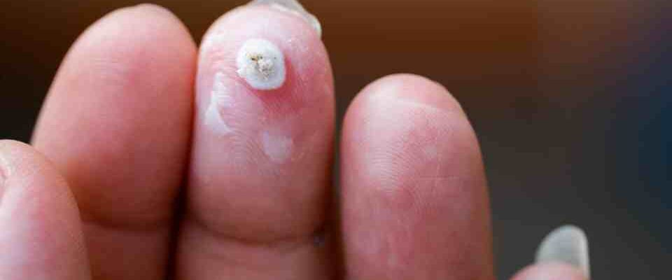 Book skin tag removal near me