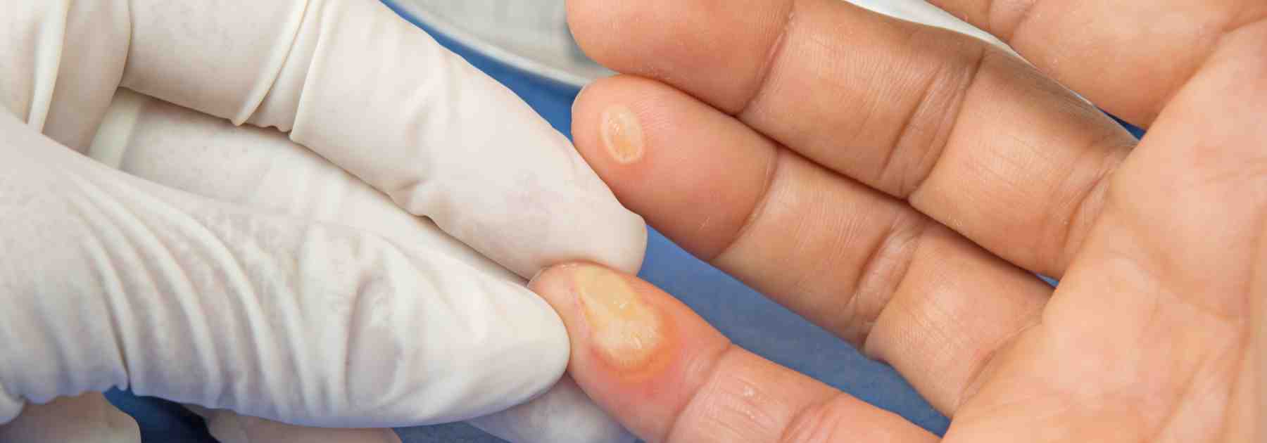 Wart removal near me in Manchester